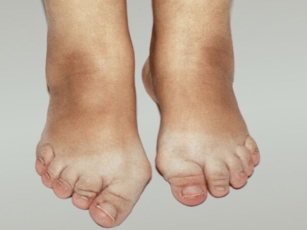Osteoartrite do pé com deformação grave dos dedos dos pés