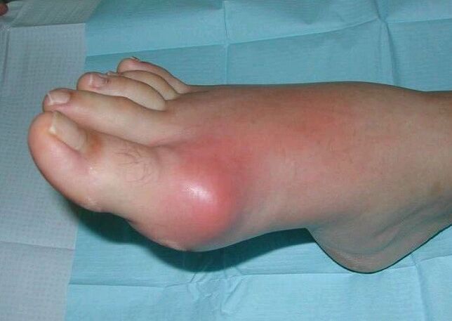 Quadro clínico de artrite nos pés - inchaço e inflamação