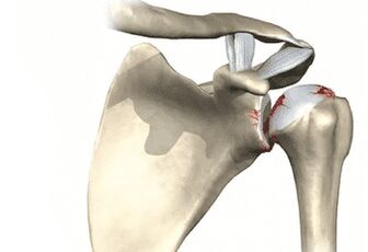 Articulação do ombro afetada por artrose