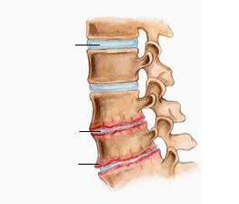 Osteocondrose