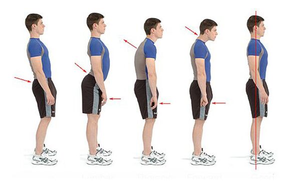Prevenção da osteocondrose