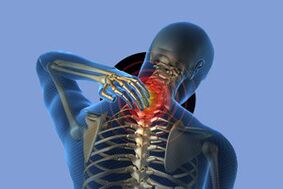 Sintomas de osteocondrose cervical