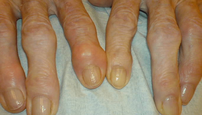 dor nas articulações dos dedos com osteoartrite