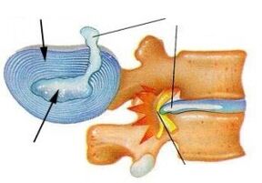destruição do anel fibroso na osteocondrose cervical