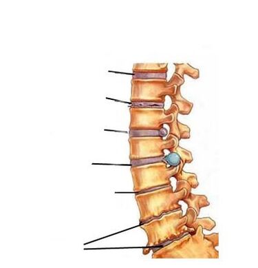 estágios de desenvolvimento da osteocondrose