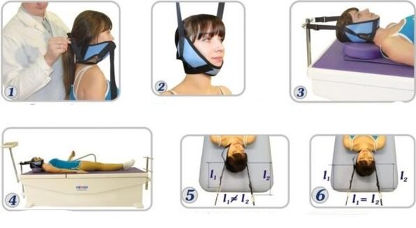 tratamento da osteocondrose cervical com tração