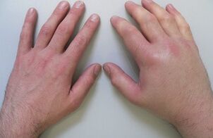 artralgia como causa de dor nas articulações dos dedos
