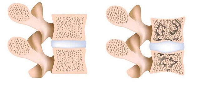 osteoporose - a remoção de cálcio dos ossos