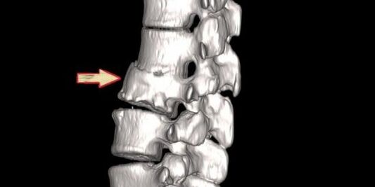 patologia espinhal como causa de dor nas costas