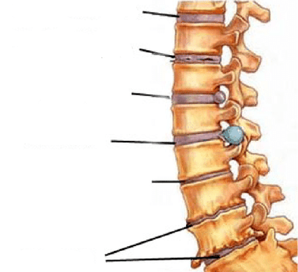 estágios de desenvolvimento de osteocondrose da coluna vertebral