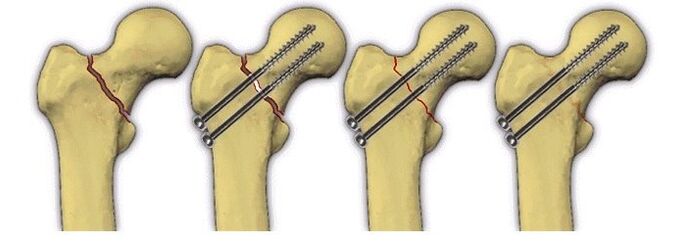 fixação do corpo ósseo com pinos para dor na articulação do quadril