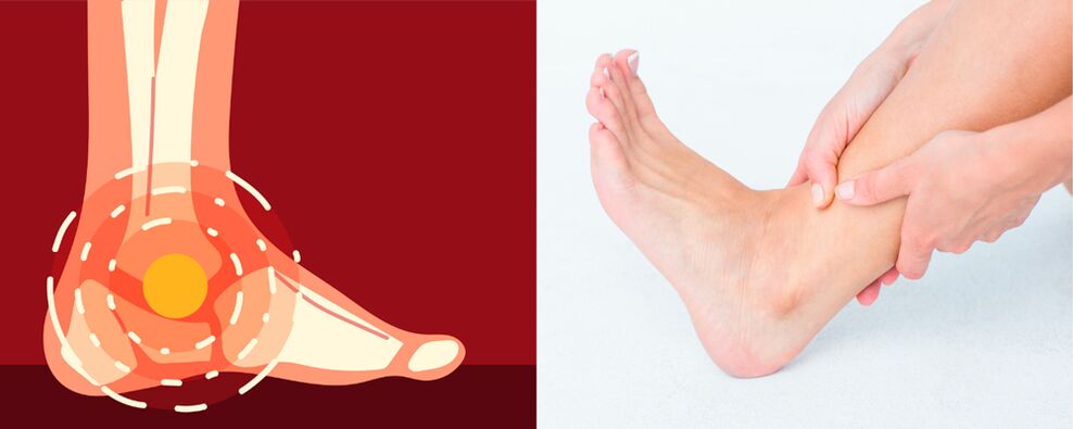 A dor na artrose deformante do tornozelo é acompanhada por inchaço, diminuição da mobilidade articular