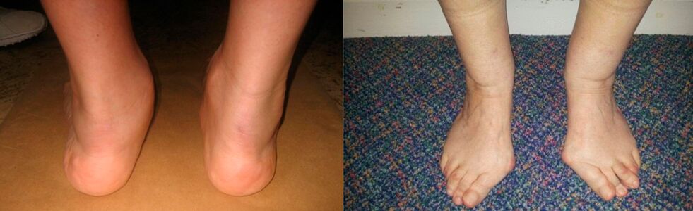 Artrose do dedão do pé e artrose deformante do tornozelo