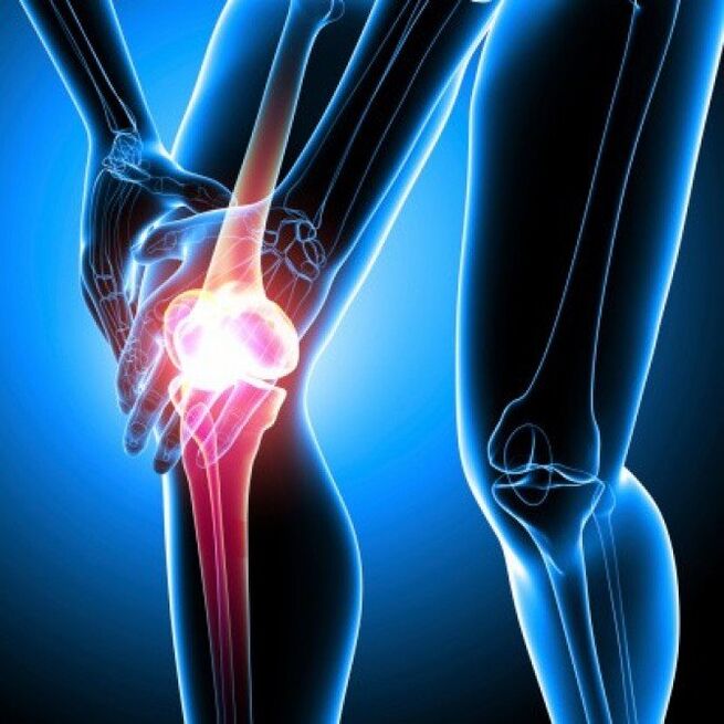 Artrite reumatóide em estágio avançado pode causar dor no quadril