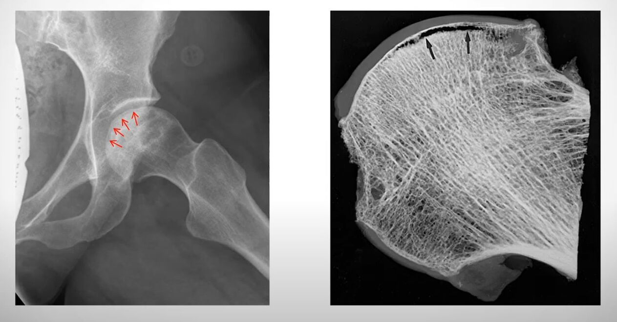 Radiografia da cabeça femoral afetada por necrose asséptica
