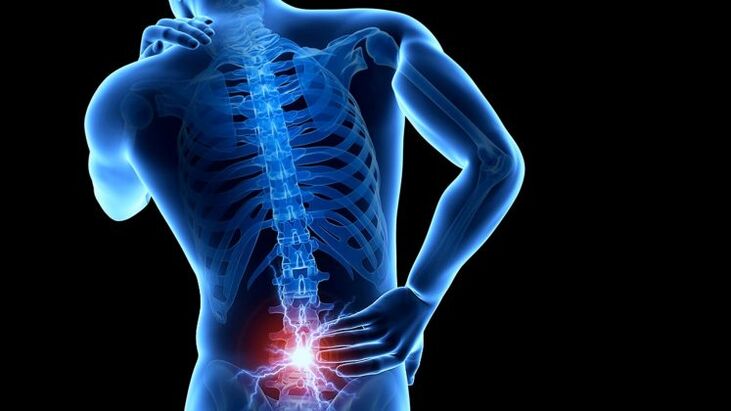 dor nas costas com osteocondrose lombar